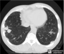 Rheumatoid Lung Nodules